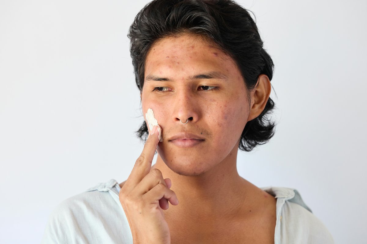 So entfernen Sie Schönheitsfehler aus dem Gesicht